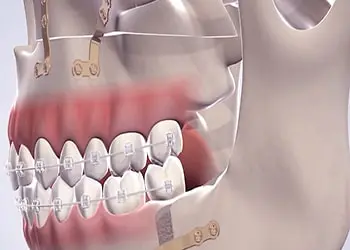 خدمات تخصصی ایمپلنت دندان implant dental