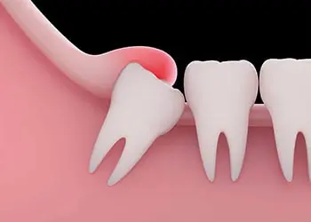 جراحی دندان عقل روی عصب فک خطرناک است؟