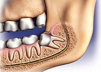 جراحی دندان عقل روی عصب فک خطرناک است؟