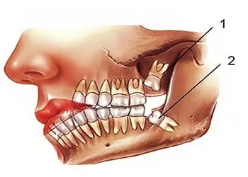 جراحی دندان عقل روی عصب فک خطرناک است؟