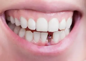 خدمات تخصصی ایمپلنت دندان implant dental