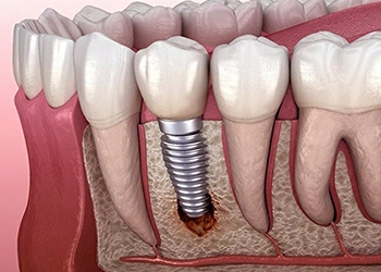 علائم جوش نخوردن ایمپلنت چیست؟